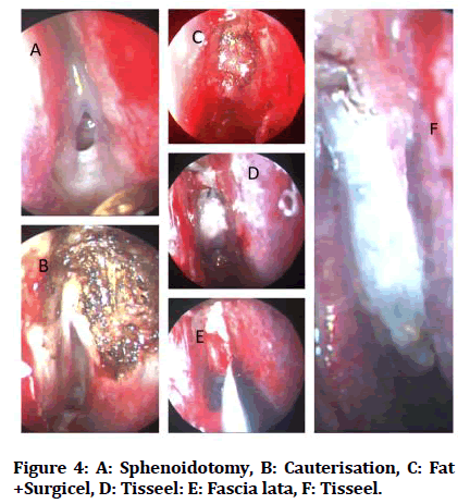 medical-dental-Sphenoidotomy