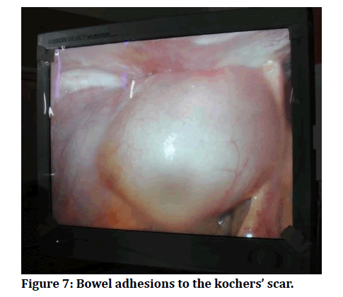 medical-dental-science-Bowel-adhesions