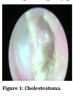 medical-dental-science-Cholesteatoma