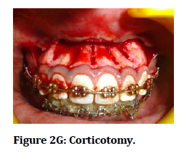 medical-dental-science-Corticotomy