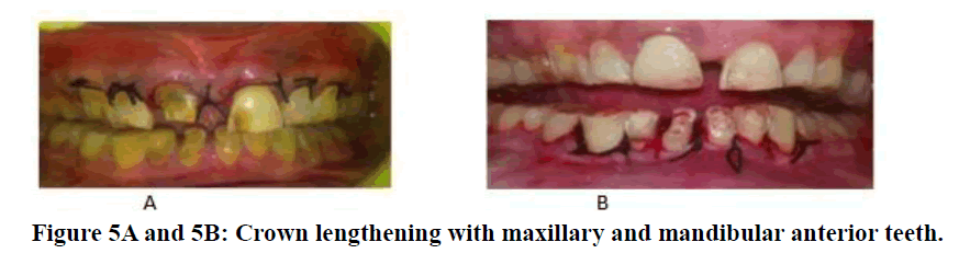 medical-dental-science-Crown-lengthening