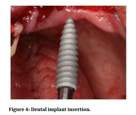 medical-dental-science-Dental-implant