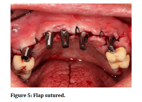 medical-dental-science-Flap-sutured