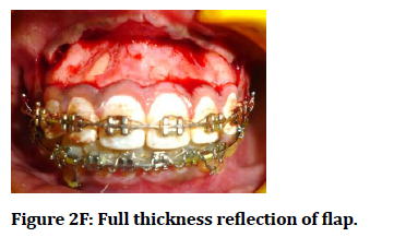 medical-dental-science-Full-thickness