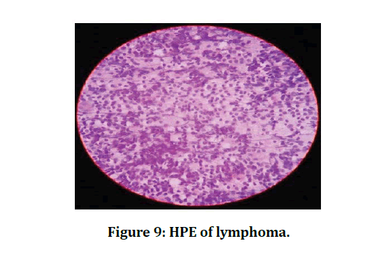 medical-dental-science-HPE-lymphoma