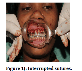 medical-dental-science-Interrupted-sutures