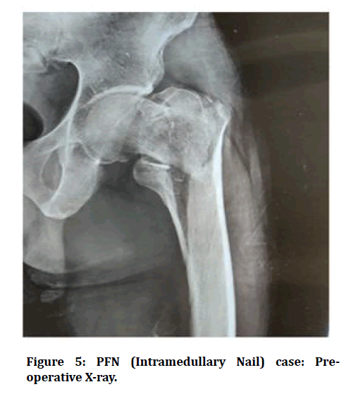 medical-dental-science-Intramedullary-Nail