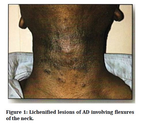 medical-dental-science-Lichenified-lesions