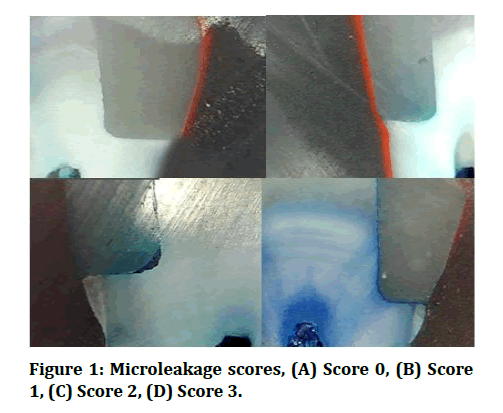 medical-dental-science-Microleakage-scores