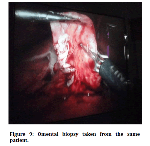 medical-dental-science-Omental-biopsy