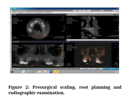 medical-dental-science-Presurgical-scaling