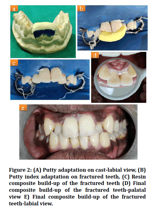 medical-dental-science-Putty-adaptation