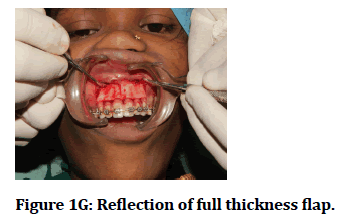 medical-dental-science-Reflection-thickness
