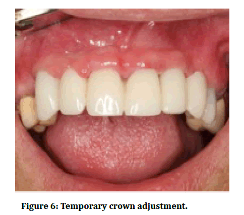 medical-dental-science-Temporary-crown