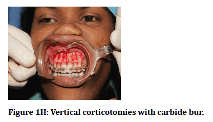 medical-dental-science-Vertical-corticotomies