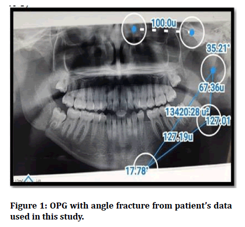 medical-dental-science-angle-fracture