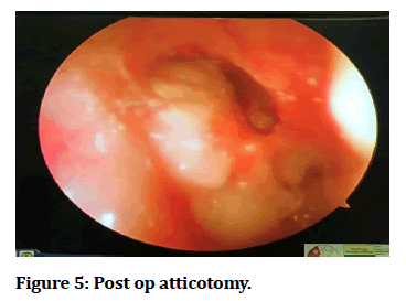 medical-dental-science-atticotomy