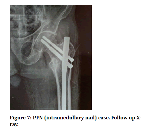 To Compare and Assess Dynamic Hip Screw and Proximal Femur Nail in  Intertrochenteric Femur Fracture