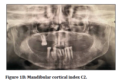 medical-dental-science-cortical-index