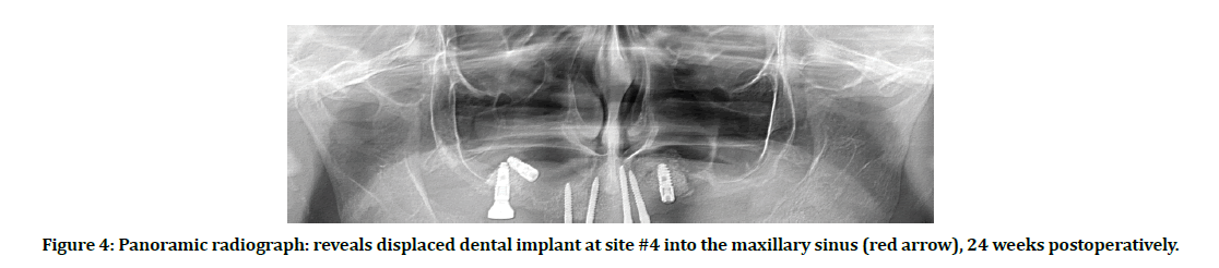 medical-dental-science-dental-implant