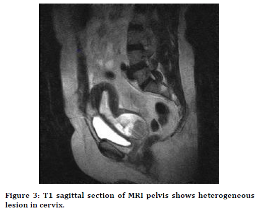 Evaluation of abnormal uterine bleeding in postmenopausal women