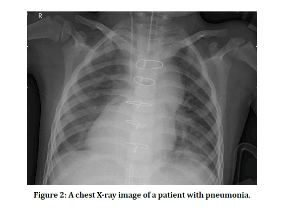 medical-dental-science-patient-pneumonia