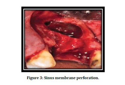 medical-dental-science-sinus-membrane