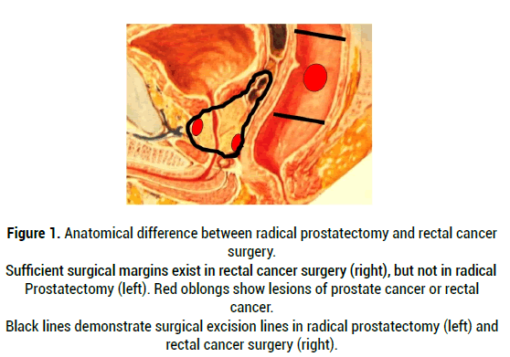 medical-reports-prostatectomy