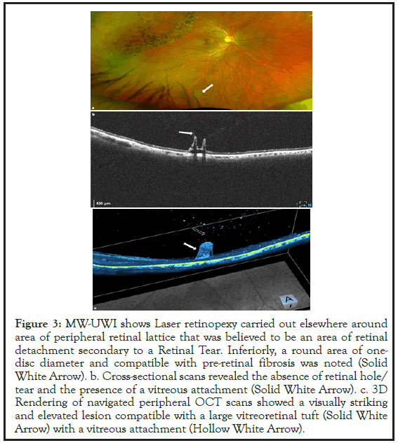 retinopexy