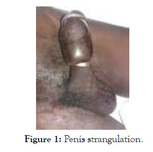 medical-surgical-urology-strangulation