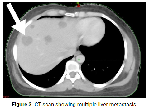 oncology-cancer-case-reports-liver