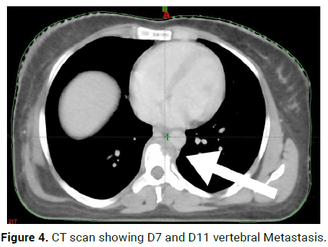 oncology-cancer-case-reports-vertebral-metastasis