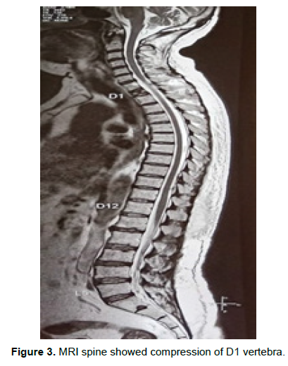oncology-cancer-compression-vertebra