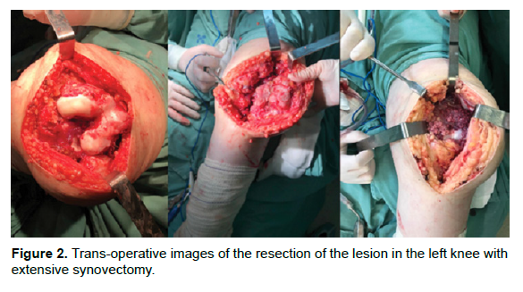 oncology-cancer-extensive-synovectomy