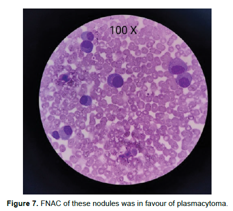 oncology-cancer-favour-plasmacytoma