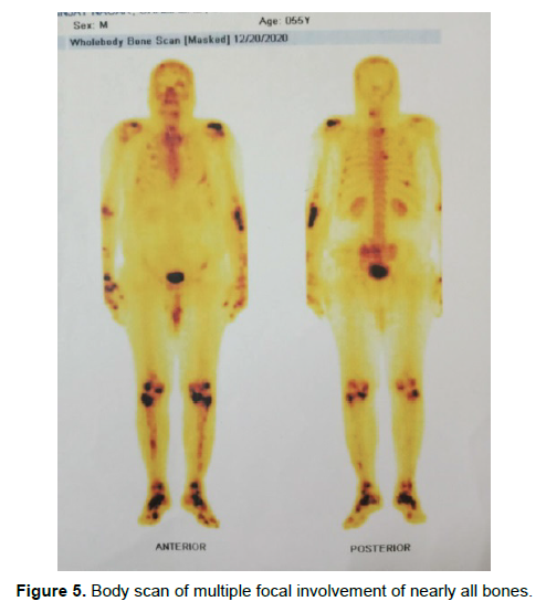 oncology-cancer-focal-involvement