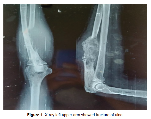 oncology-cancer-fracture-ulna