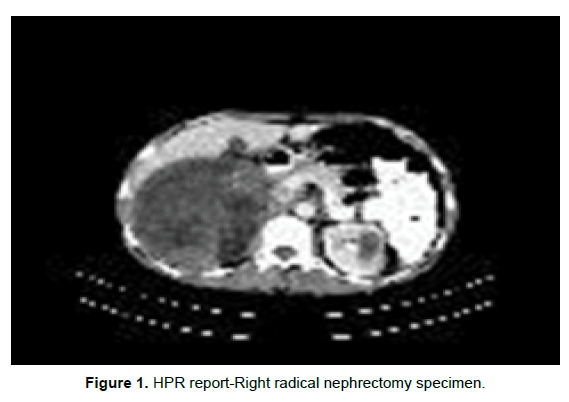 oncology-cancer-nephrectomy-specimen