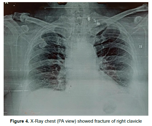 oncology-cancer-right-clavicle