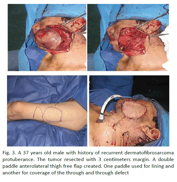 oncology-radiotherapy-dermatofibrosarcoma