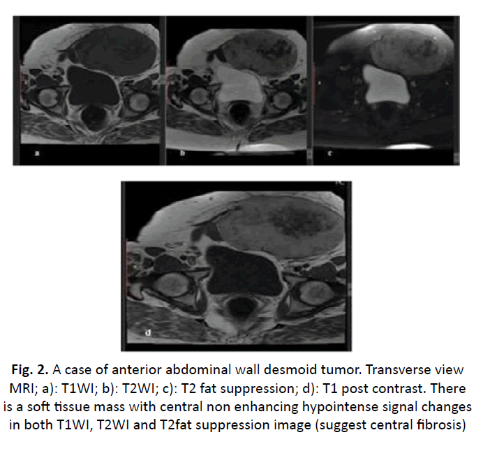 oncology-radiotherapy-desmoid-tumor