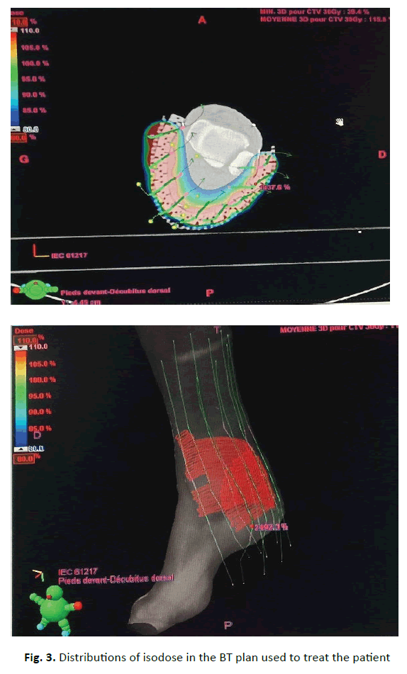 oncology-radiotherapy-distributions-isodose