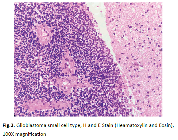 oncology-radiotherapy-glioblastoma-small