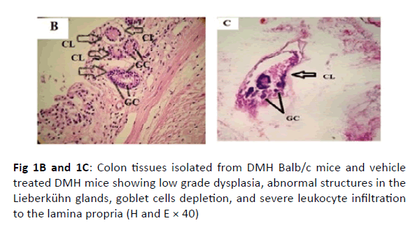 oncology-radiotherapy-grade-dysplasia