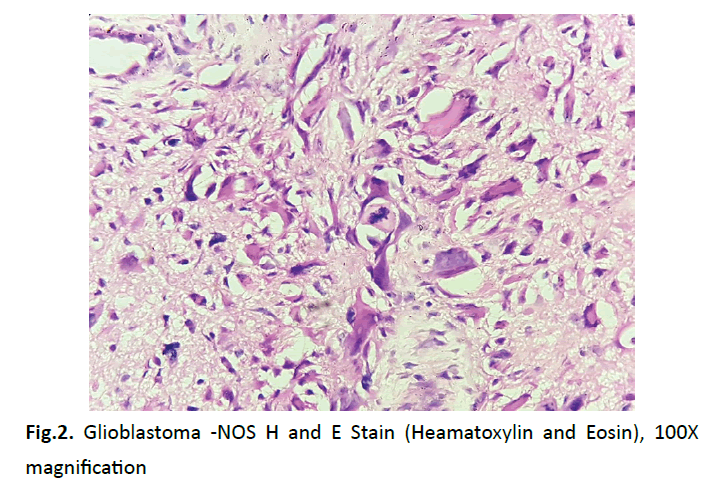 oncology-radiotherapy-heamatoxylin-eosin