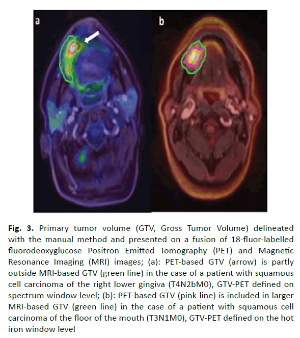 oncology-radiotherapy-manual-method