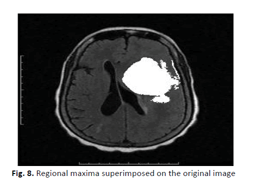 oncology-radiotherapy-maxima-superimposed