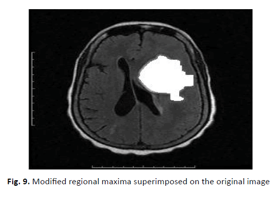 oncology-radiotherapy-maxima-superimposed
