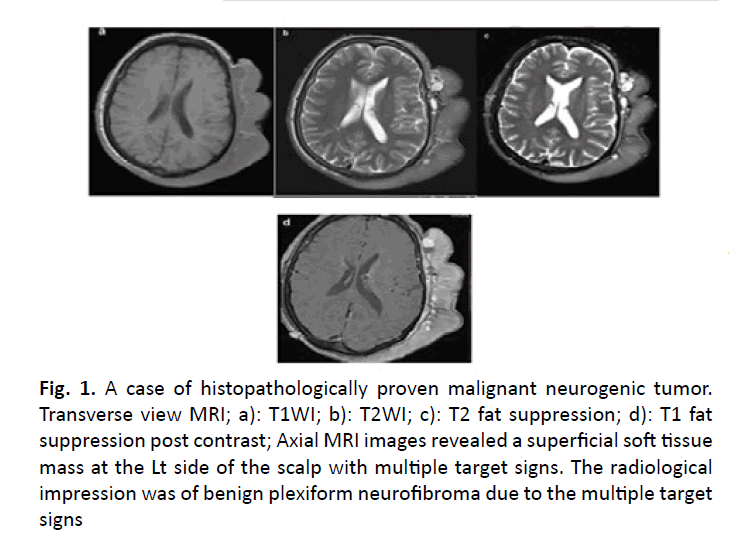 oncology-radiotherapy-neurogenic-tumor