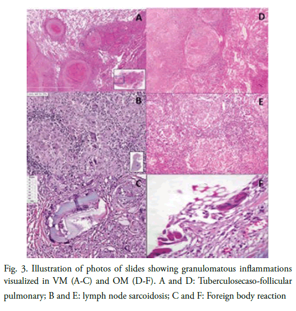 oncology-radiotherapy-node-sarcoidosis